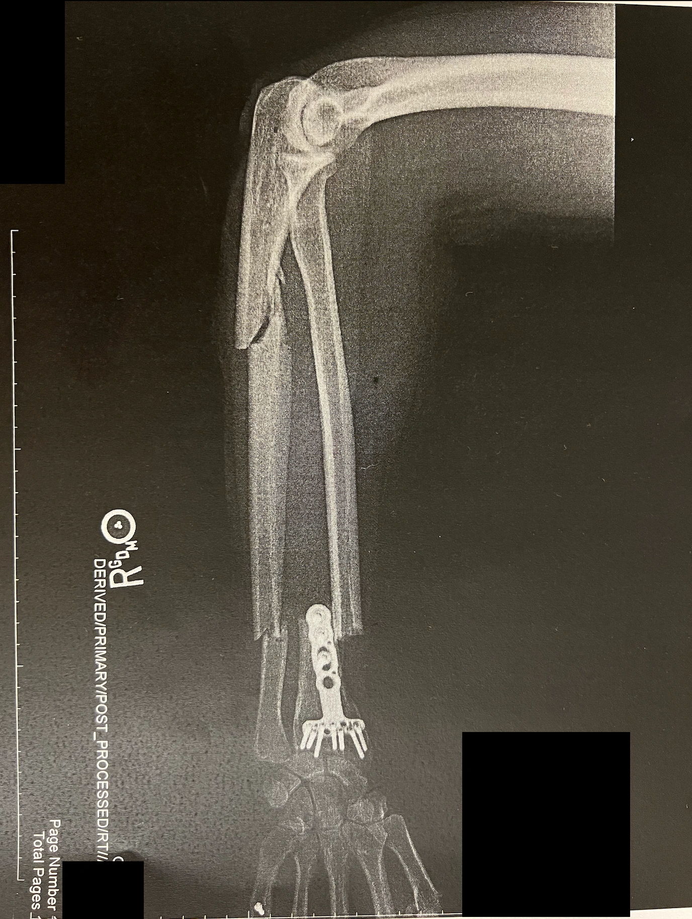 Preoperative Right Forearm X-Ray Showing A Radius Fracture Beside Prior Hardware And Segmental Fractures Of The Ulna. Preoperative Right Forearm X-Ray Showing A Radius Fracture Beside Prior Hardware And Segmental Fractures Of The Ulna.