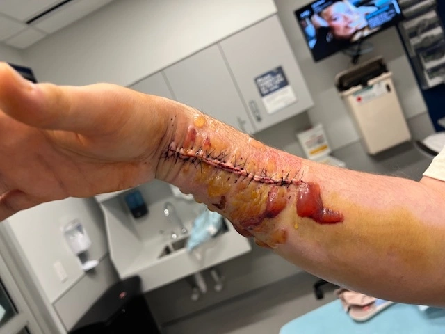Clear Fluid-Filled Fracture Blisters On The Client’s Right Forearm After The Abbottstown Car Accident. Clear Fluid-Filled Fracture Blisters On The Client’s Right Forearm After The Abbottstown Car Accident.
