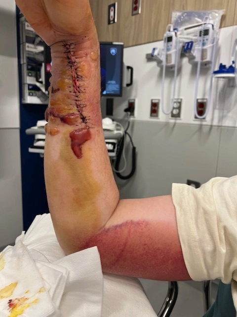 Blood-Filled Fracture Blisters On The Client’s Right Forearm Following The Radius And Ulna Fractures. Blood-Filled Fracture Blisters On The Client’s Right Forearm Following The Radius And Ulna Fractures.
